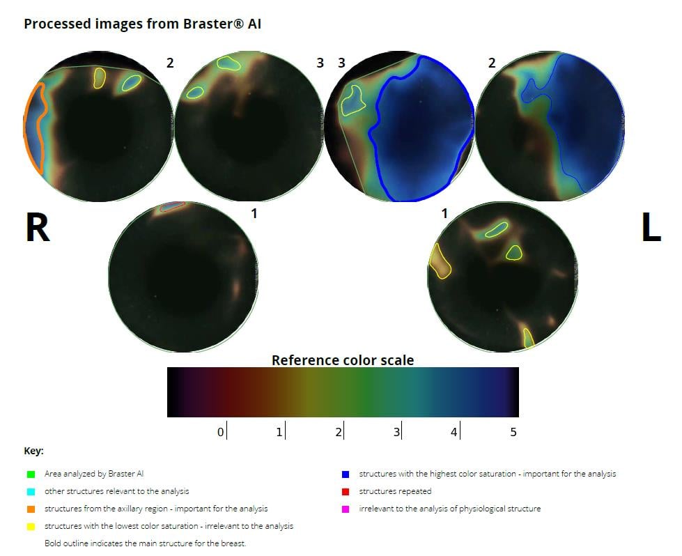 Automatic Thermography Test Interpretation - Abnormal