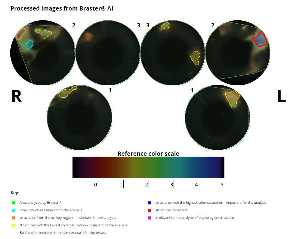 Automatic Thermography Test Interpretation - Normal